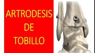 artrodesis de tobillo tips