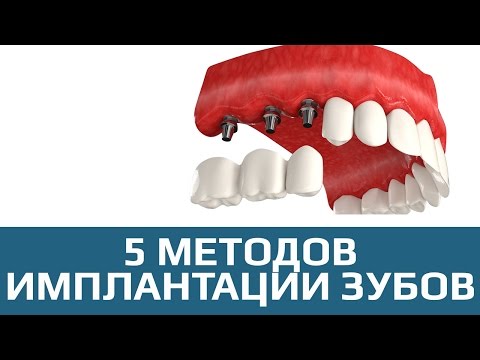 Можно ли мне сделать имплантацию при гипертиреозе? Противопоказания к имплантации зубов