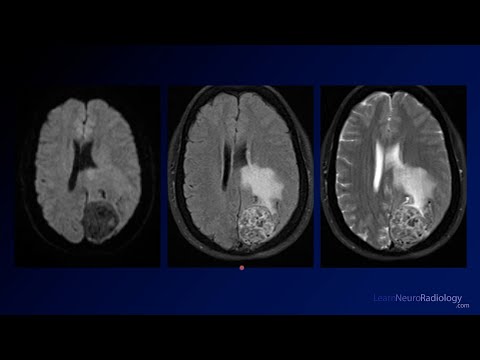 Neuroradiology Board Review - Brain Tumors - Case 14