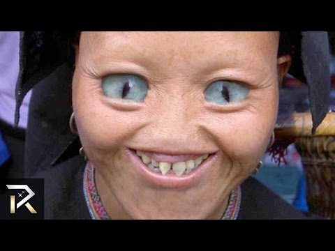 10 Real People With Genetic Mutations