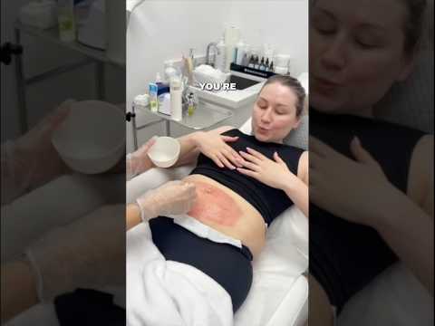 STRETCH MARK REMOVAL TEST pt.1