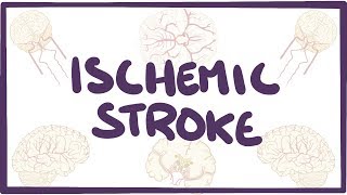 Download Lagu Ischemic Stroke - causes, symptoms, diagnosis, treatment, pathology Thumbnail