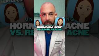What’s the difference between regular and hormonal acne Derm explains! #hormonalacne
