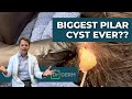 BIGGEST Pilar Cyst Ever Dr Derm
