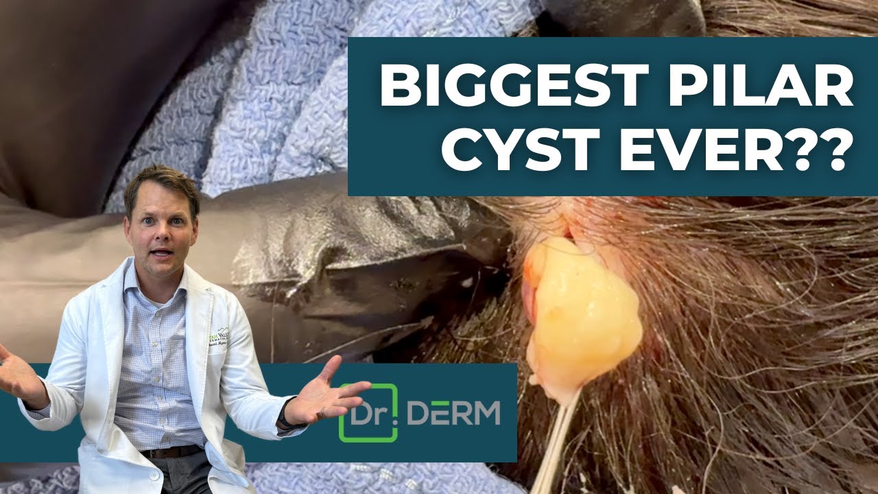 BIGGEST Pilar Cyst Ever?? | Dr. Derm