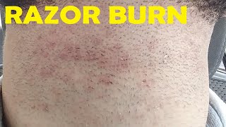 how to get rid of razor burn on neck fast