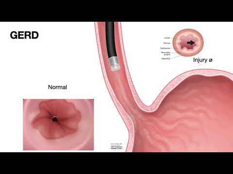 HCC 1475-2e-Pathology of Esophagus - Peptic Stricture