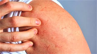 How to Get Rid of Hives on Body Fast | Home Remedies for Chronic Hives.