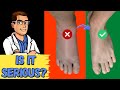 How To Tell If My Foot or Ankle Injury is BAD! [Sprained or BROKEN?]