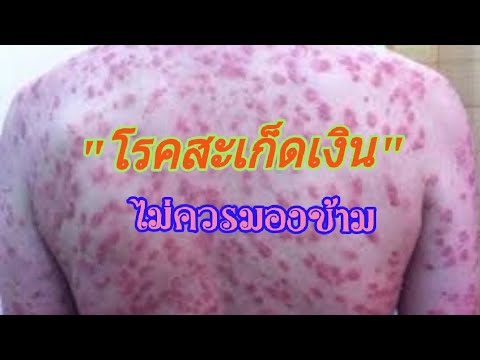 คนที่ได้รับการกำจัดของโรคสะเก็ดเงิน โรคสะเก็ดเงินเข้าไปในกองทัพ