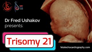 Trisomy 21: Challenges in screening, diagnosis and management of Down