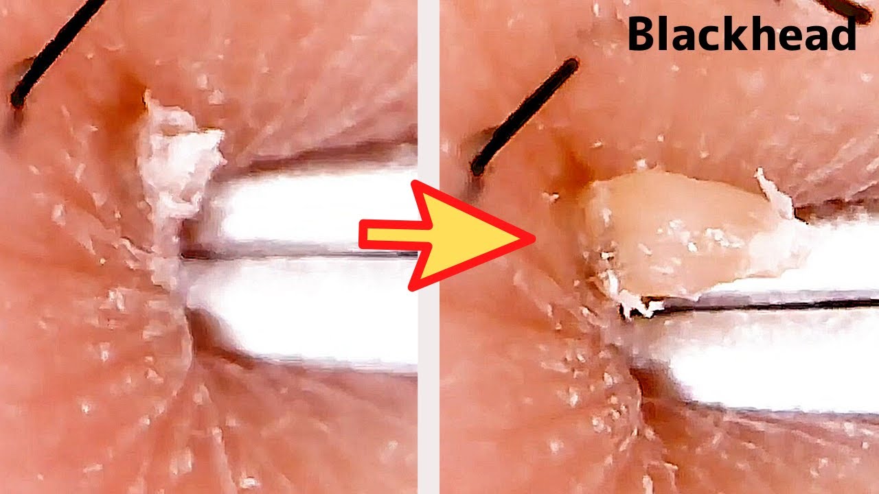 【角栓除去】ズボっと！大量のニキビを芯出しするのって気持ちいい／Blackhead Removal Show