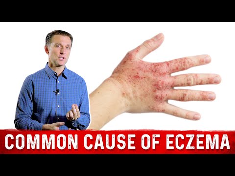 Dermatite di seboreyny e cura di psoriasi Sintomi di dermatite di atopic e prevenzione di trattamento di una fotografia