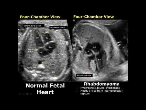 Fetal Chest Ultrasound Normal Vs Abnormal Image Appearances | Echocardiography | Heart & Lungs USG