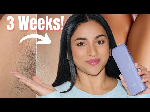 I Tried Ulike IPL Hair Removal at Home (Before/After...