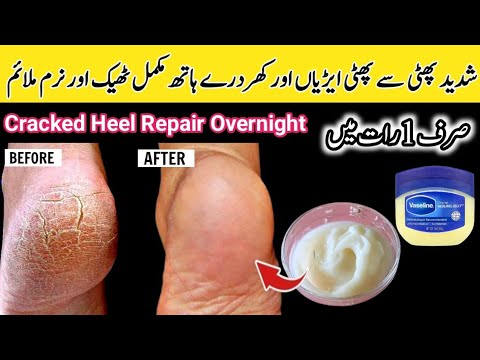 Hands Feet Repair Cream | DIY Hand & Feet Bleach | Hand Whitening | Cracked Heels Repair Overnight👣