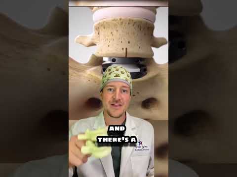 Two Types of Disc Replacements (spine surgeon explains)