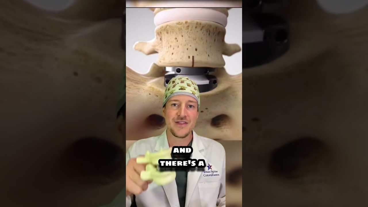 Two Types of Disc Replacements (spine surgeon explains)