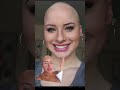 The Way My Face Hair Changed Each Year Hairloss Alopecia Bald Alopeciaawareness Viral