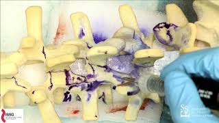 Osteotomies for Sagittal Malalignment  - Shay Bess, MD, & Eric O. Klineberg, MD, MS