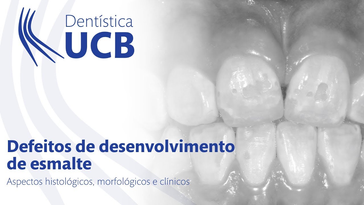 Defeitos de desenvolvimento de esmalte - Aspectos histológicos, morfológicos e clínicos