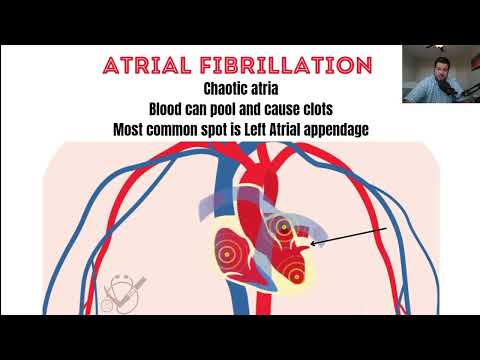 What Causes Stroke in Atrial Fibrillation (Afib)?