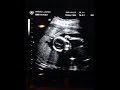 Week 20 Update, Baby's Sex + Live ultrasound fun ...