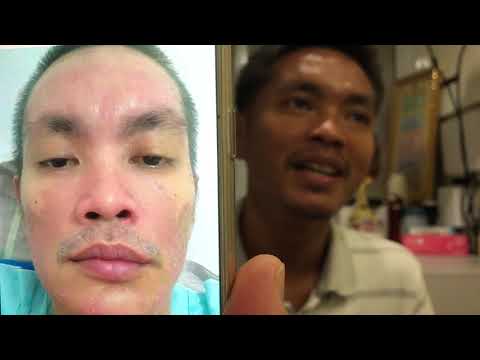แสงแดดในโรคสะเก็ดเงิน โรคสะเก็ดเงินบนขอบของริมฝีปาก