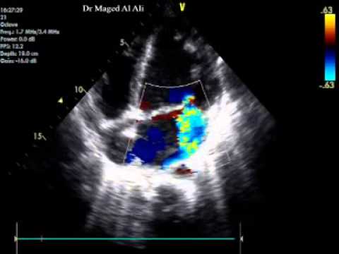 LV Noncompaction, Dilated Cardiomyopathy and Mitral Valve Prolapse