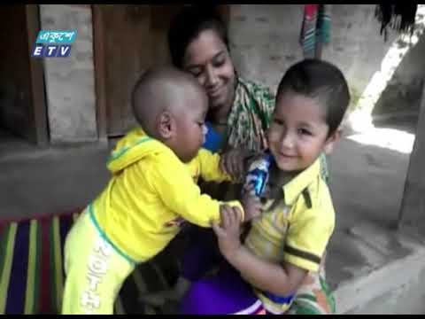 ইটিভিতে সংবাদ প্রচারের পর চিকিৎসা হওয়া শিশুটি এখন গুটিগুটি পায়ে হাঁটে | ETV News