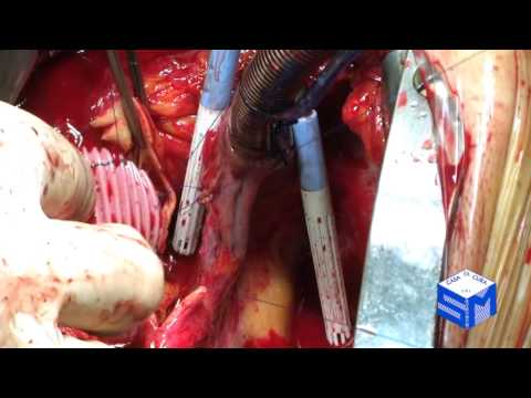 Ascending Aortic Replacement Operation