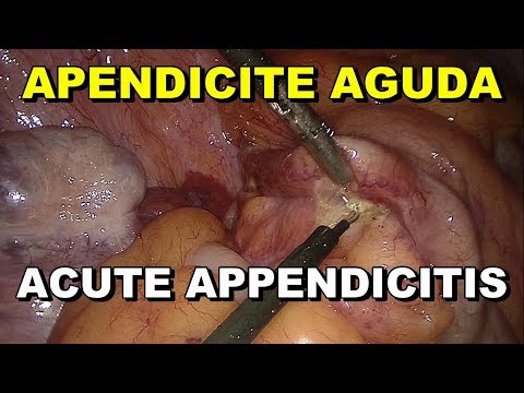 Cirurgia de Apendicite Aguda - 1 dia de dor - Sangramento de Meso - Abril 2018 - FullHD + GoPro Video