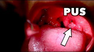 GIANT TONSILS WITH WHITE PUS (Strep Throat? / Mono?) | Dr. Paul