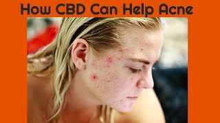 CBD For Treating Acne - CBD Is A Powerful Natural Alternative For Acne Treatment