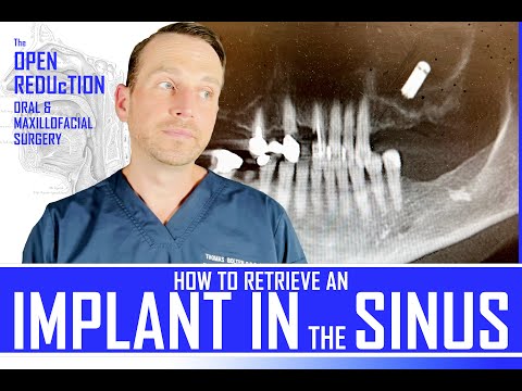 Dental Implant Falls Into the Sinus | How To Retrive with Caldwell Luc Approach