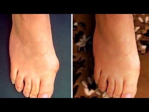 Immaturità fisiologica delle articolazioni dellanca in neonati tipo 2a Dolori articolari e pielonefrite