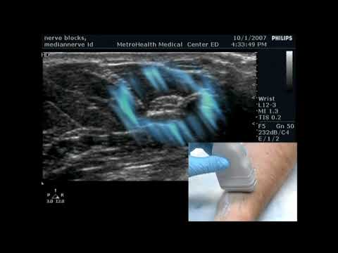 Ultrasound  Forearm Nerve Blocks
