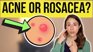 IS IT ACNE OR ROSACEA? 😳 Dermatologist @DrDrayzday
