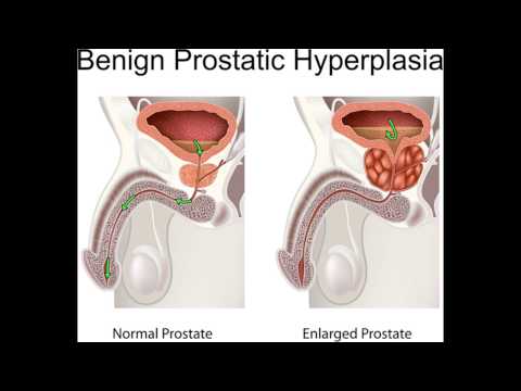 Prostata-Norm Transkript Das Vorhandensein von Prostata-Steine