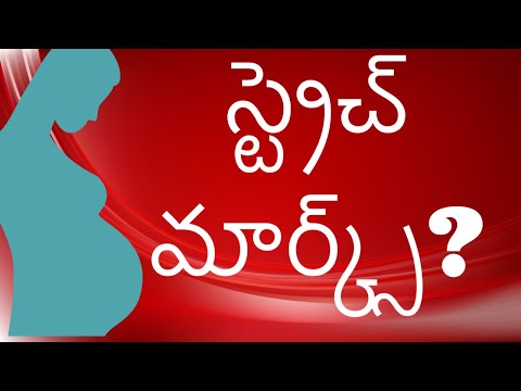 ప్రెగ్నెన్సీ స్ట్రెచ్ మార్క్స్ పోతాయా? - normal delivery - pregnancy and childcare