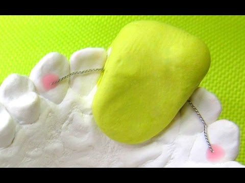 Bonded Lingual Retainer with Tray, Orthodontics Kieferorthopädie KFO