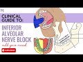 Inferior Alveolar Nerve Block Explained Anatomy Halstead Technique Complications