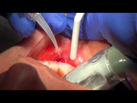 LASER Frenectomy-NWA dentist uses lasers in dentistry