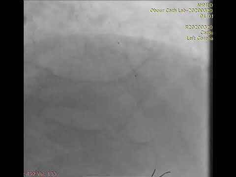 PCI to CTO LAD using microcatheter assisted antegrade wire escalation (case 2)