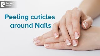 What to do for peeling cuticles around nails? - Dr. Rasya Dixit | Doctors
