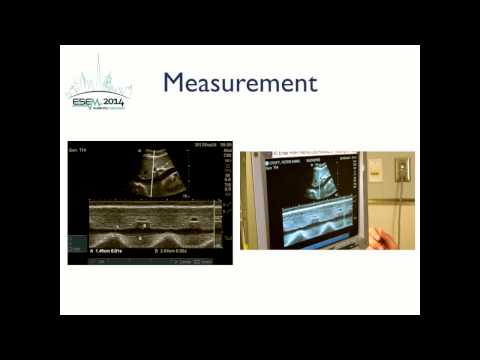 Inferior Vena Cava Ultrasound