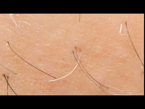 Macro Timelapse Of Hair Growing For A Month