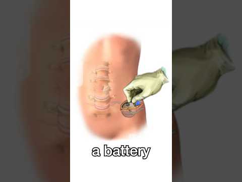 Placing a Spinal Cord Stimulator