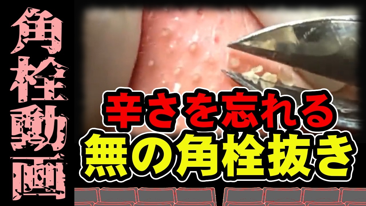 【 角栓抜き動画 】辛さを忘れる角栓抜き動画。A bottle opener video that will make you forget how spicy it is.