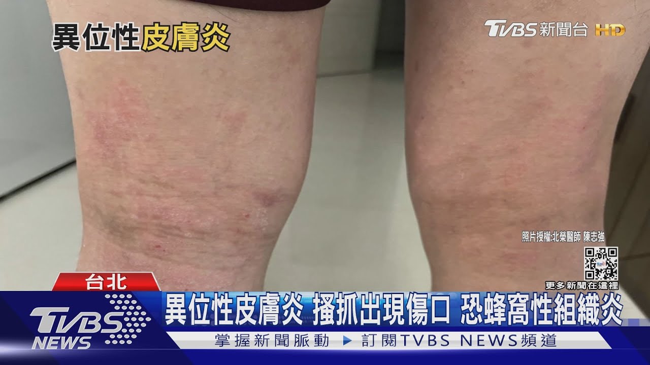 有片/孩童出現這些症狀「異位性皮膚炎」找上門 醫警告:不可搔抓